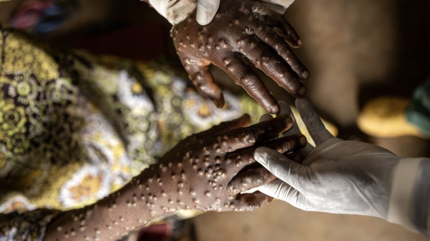 Eerste vaccins tegen mpox aangekomen in Congo