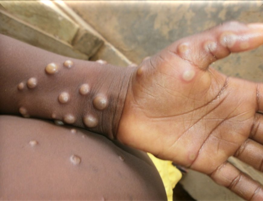 WHO prekwalificeert eerste vaccin tegen mpox