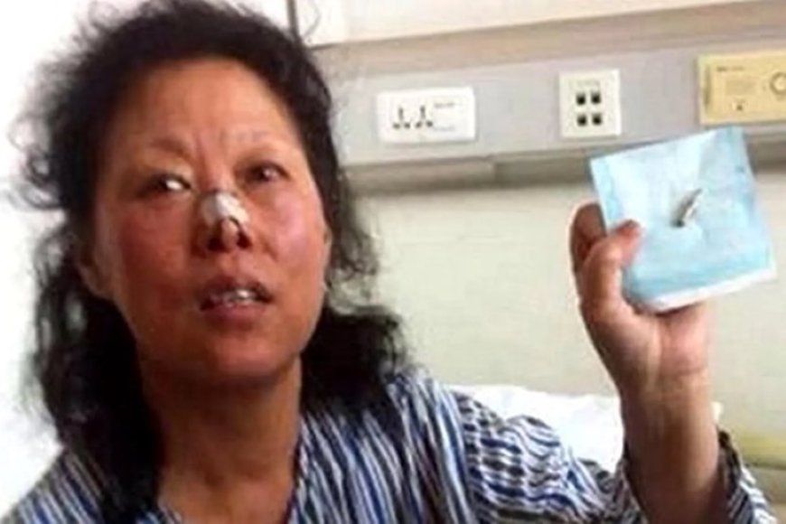 WIST U DAT: Een vrouw in China 48 jaar heeft rondgelopen met een kogel in haar neus?